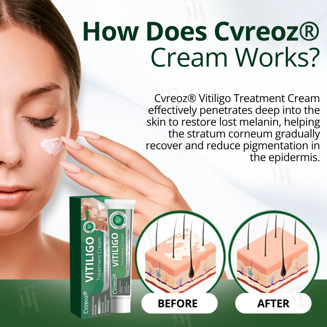 Cvreoz® Vitiligo Treatment Cream