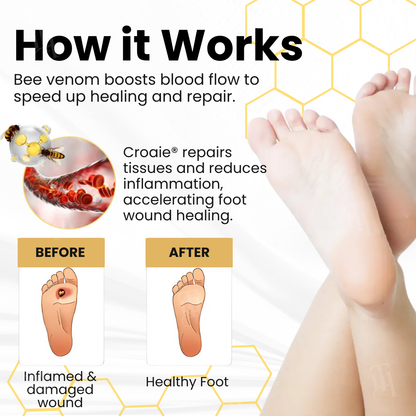 Croaie® Bee Venom Diabetic Foot Ulcer Spray
