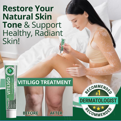 Cvreoz® Vitiligo Treatment Cream