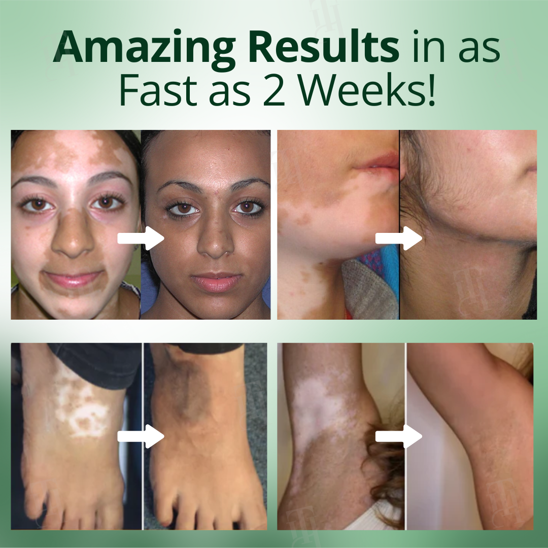 Cvreoz® Vitiligo Treatment Cream