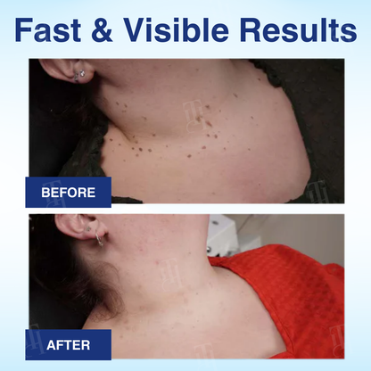 🌟 Official Store | Cvreoz® AHA Wart Removal Liquid