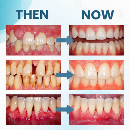 🔥The FDA-Approved Solution🌟 Official Store | AEXZR® Makesmile Bee Venom Oral Treatment Powder