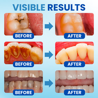 🦷 Fills Micro-Defects & Stops Sensitivity | AEXZR® Postbiotics Anti-Plaque Oral Serum