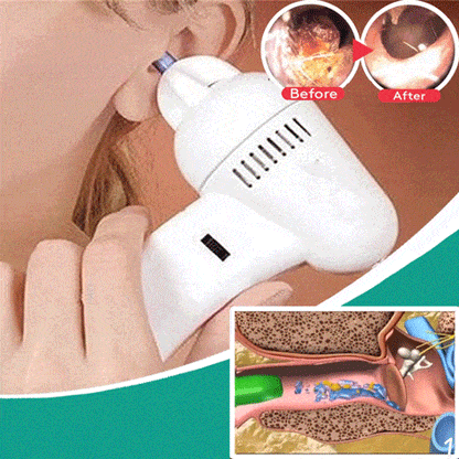 RZXEA™  Ear Wax Easy Remover